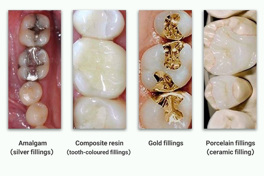 Teeth Cleaning (Scaling & Polishing) - Copy