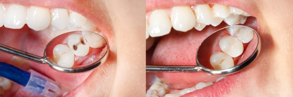 Teeth Cleaning (Scaling & Polishing) - Copy