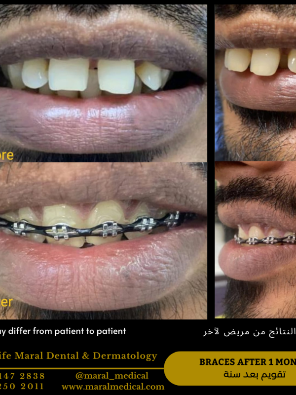 Braces orthodontist in dubai best clinic near me fix crooked teeth better smile