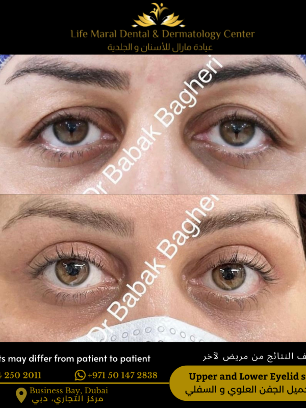 Eyelid surgery Blepharoplasty Upper and lower to remove undereye bags and undereye circles and droopy eyelids younger and fresh look best blepharoplasty in dubai best plastic surgeon best clinic in dubai