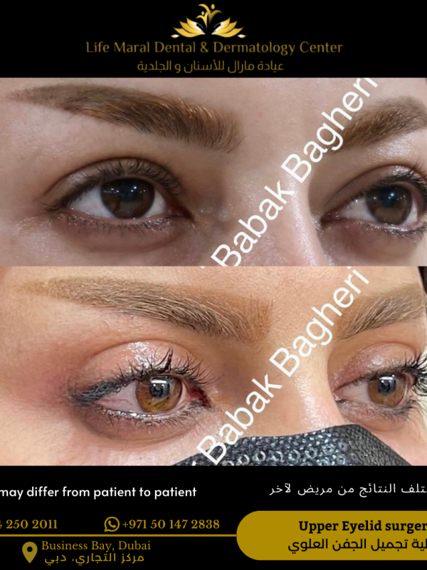 Eyelid surgery Blepharoplasty Upper and lower to remove undereye bags and undereye circles and droopy eyelids younger and fresh look best blepharoplasty in dubai best plastic surgeon best clinic in dubai