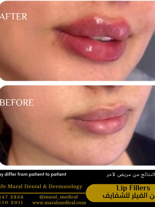 best clinic Dubai maral medical dental center lip fillers dermatology