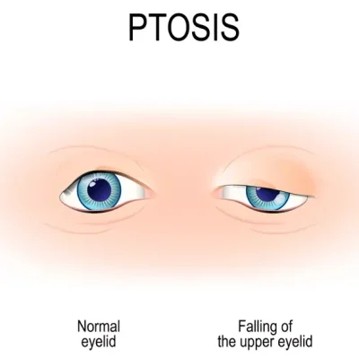 Best Ptosis Surgery (eyelid surgery) in Dubai