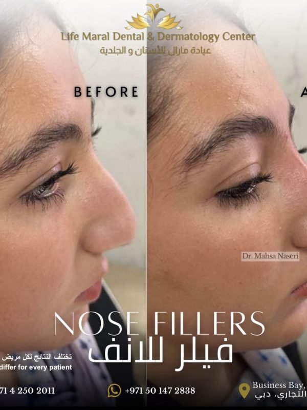 nonsurgical nose job nose fillers safe and painless best dermatologist in dubai dental clinic near me