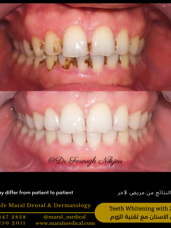 Teeth Cleaning scaling and polishing for smokers dental care Teeth Whitening with Zoom Technology Teeth Bleaching Best Dentist in Dubai Best Dental Clinic near me business bay deira