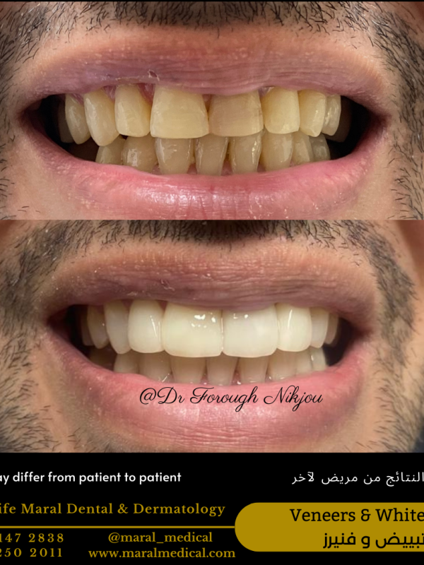 veneers hollywood smile Teeth Whitening with Zoom Technology Teeth Bleaching Best Dentist in Dubai Best Dental Clinic near me business bay deira