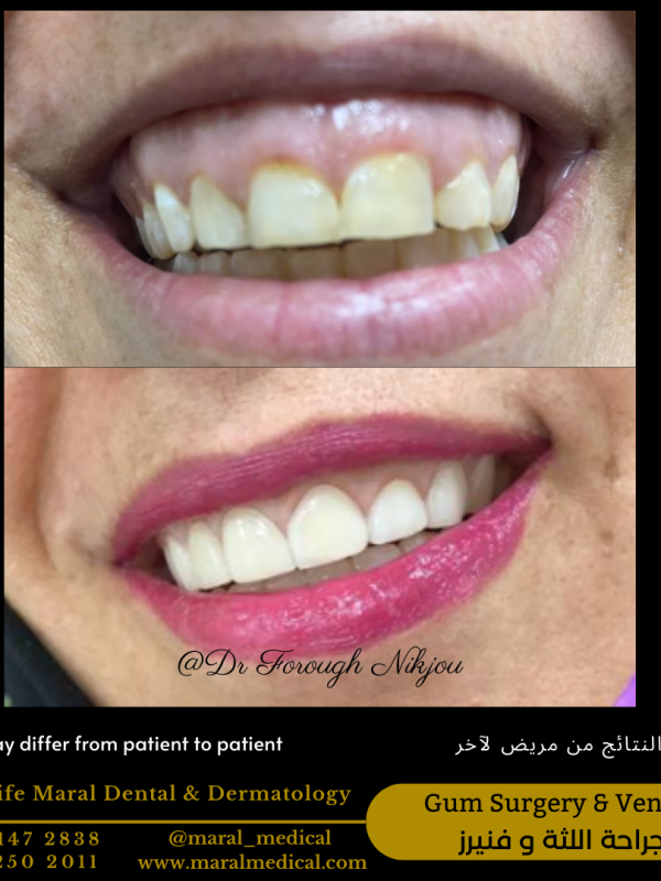 Veneers Hollywood Smile Gum Surgery to improve gummy smile painless Best Dentist in Dubai Best Dental Clinic near me business bay deira