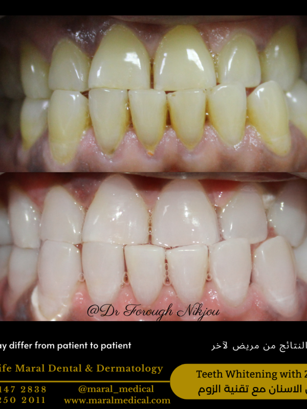 Teeth Whitening Zoom Best Dentist in Dubai dr forough maral medical dental center