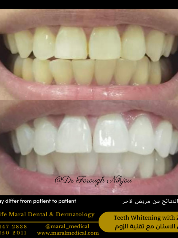 Teeth Whitening Zoom Best Dentist in Dubai dr forough maral medical dental center