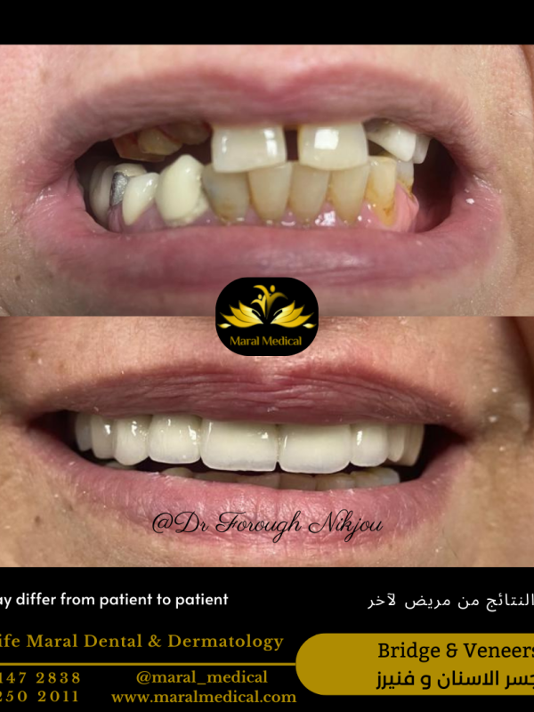 veneers bridge for missing tooth Teeth Whitening with Zoom Technology Teeth Bleaching Best Dentist in Dubai Best Dental Clinic near me business bay deira Veneer Bridge Crown Teeth Best Dubai Clinic