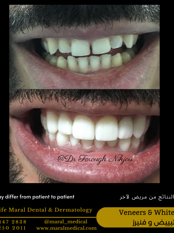 Veneers Hollywood smile best clinic dubai best dentist dr forough